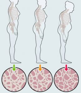 Osteoporosis little known facts